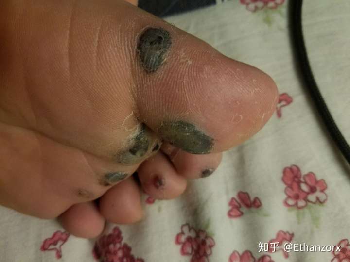 跖疣和鸡眼有什么区别,医学上有没有什么治疗跖疣的好