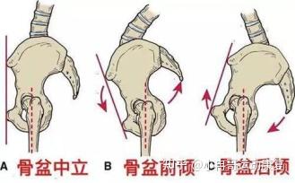 怎么判断自己是骨盆前倾还是骨盆后倾