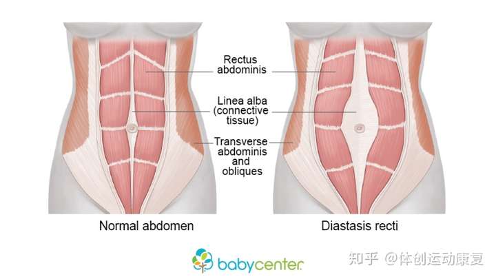 腹直肌分离并不是因为最外层的腹直肌无力而分开,而是因为深层的腹横