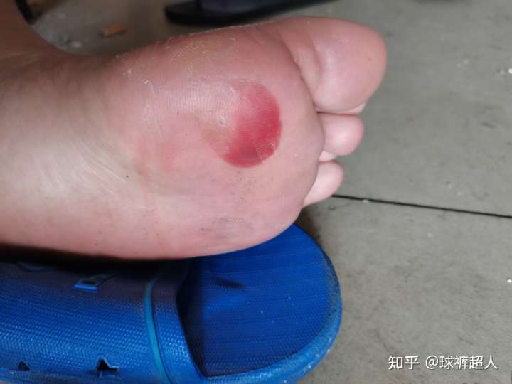 跑步时脚上被鞋磨出了拇指甲那么大的水泡,要不要挤破
