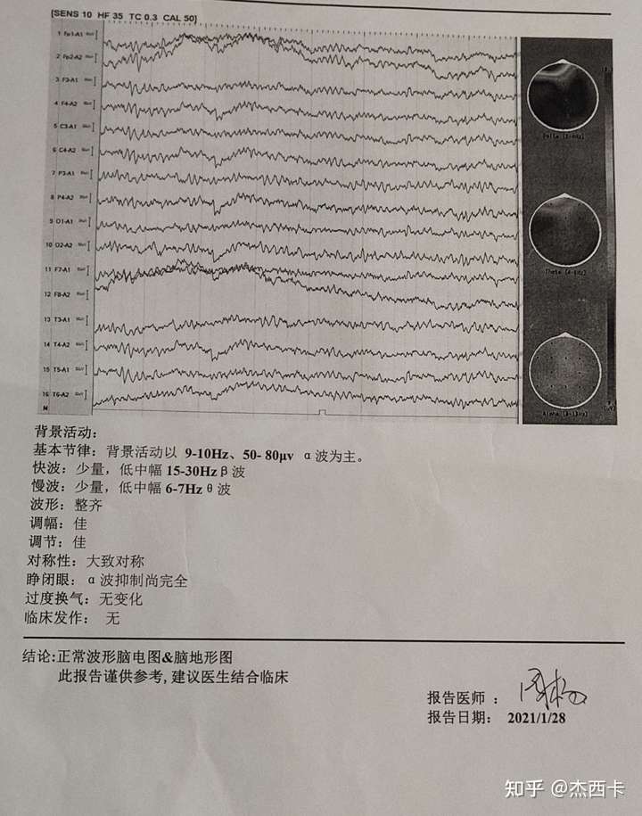 我的脑电图