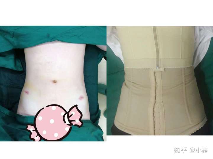 腰腹吸脂去重庆哪家医院好?