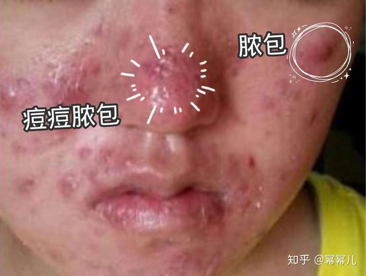 酒糟鼻有人治好过吗
