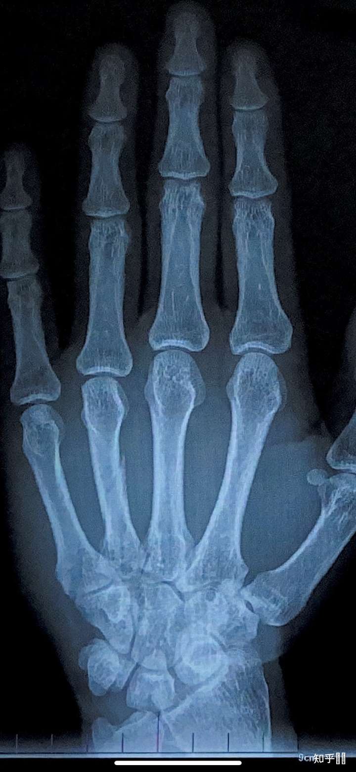 右手第四掌骨骨折保守治疗的第16天,恢复的是否不太理想?