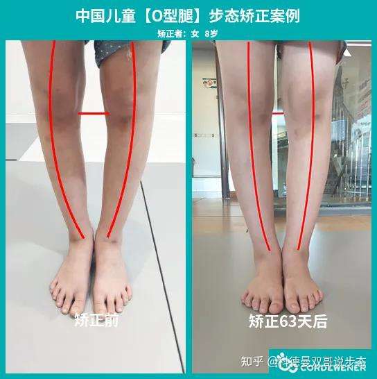 请问我17岁这种o型腿还能矫正吗?