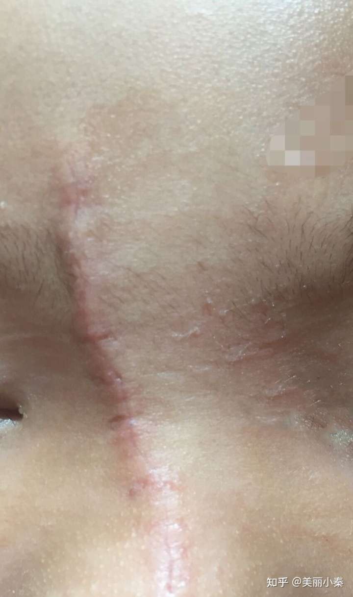 脸上缝针疤痕怎么去除