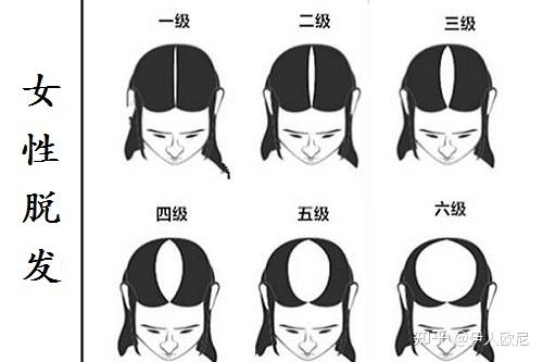 女性头顶中间又长又宽的发逢 快延伸到后脑勺了请问算脱发吗?
