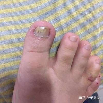 灰指甲看什么科