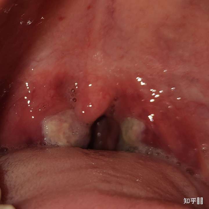 吃了阿莫西林 没有好转  自己在镜子前看了 扁桃体上有了白点已经开始