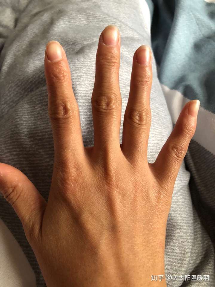经常掰指节手指关节变粗且关节处皮肤变黑怎么处理?可以还原吗?