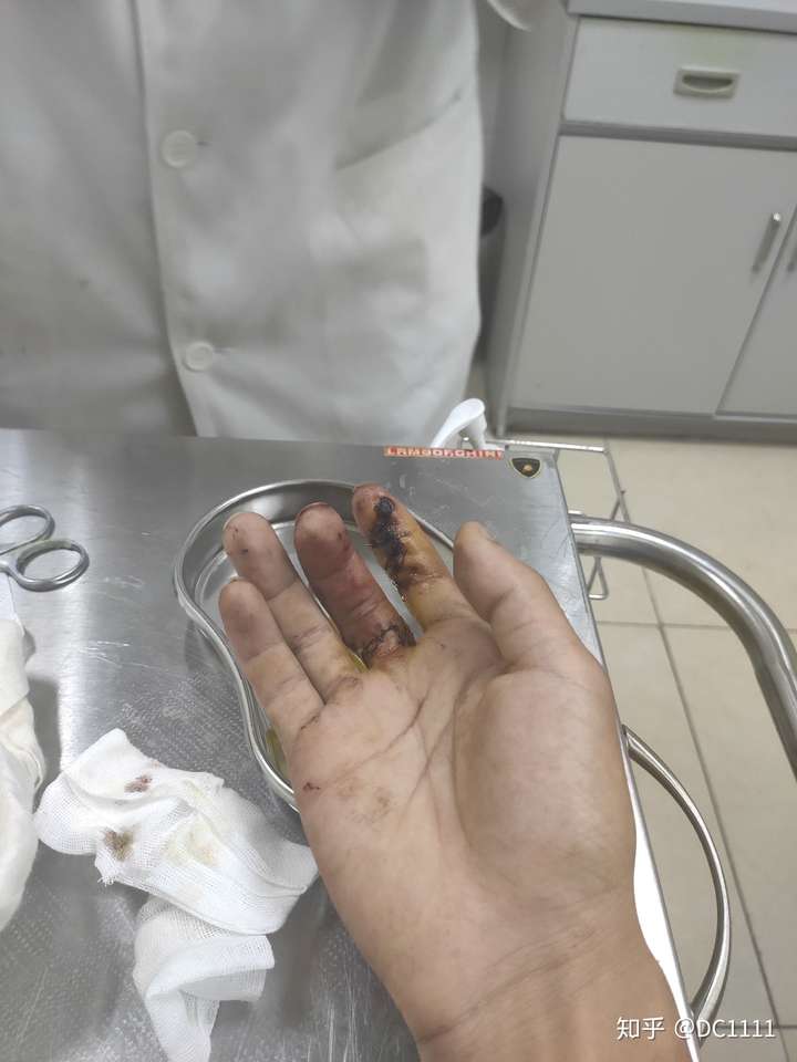 被电锯割伤,看了伤口赶忙去医院,路上晕倒了几分钟,太血腥了.