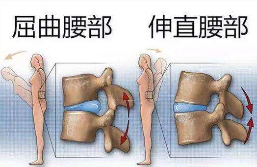 腰椎间盘突出可以自愈吗