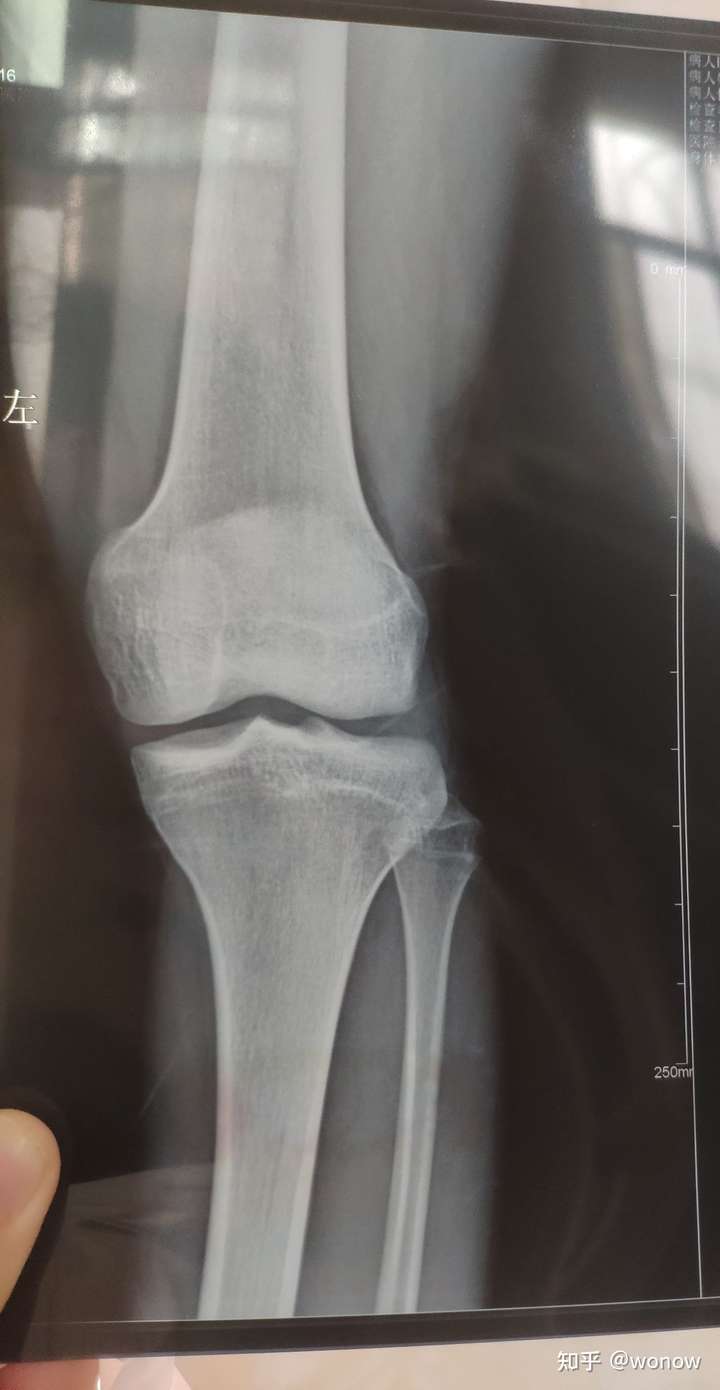 骨骺线算闭合了吗?