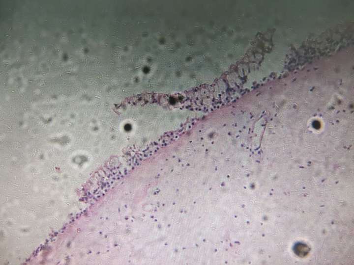 鼻息肉的病理切片红蓝铅笔绘图有吗