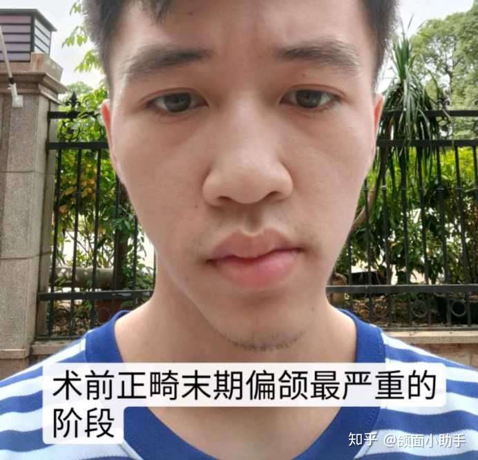 偏颌要怎么自我改善?