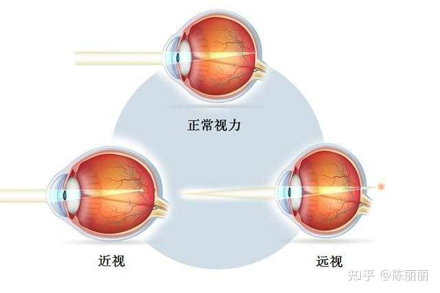 近视眼,远视眼等人的各种眼睛看到的世界各是什么样子