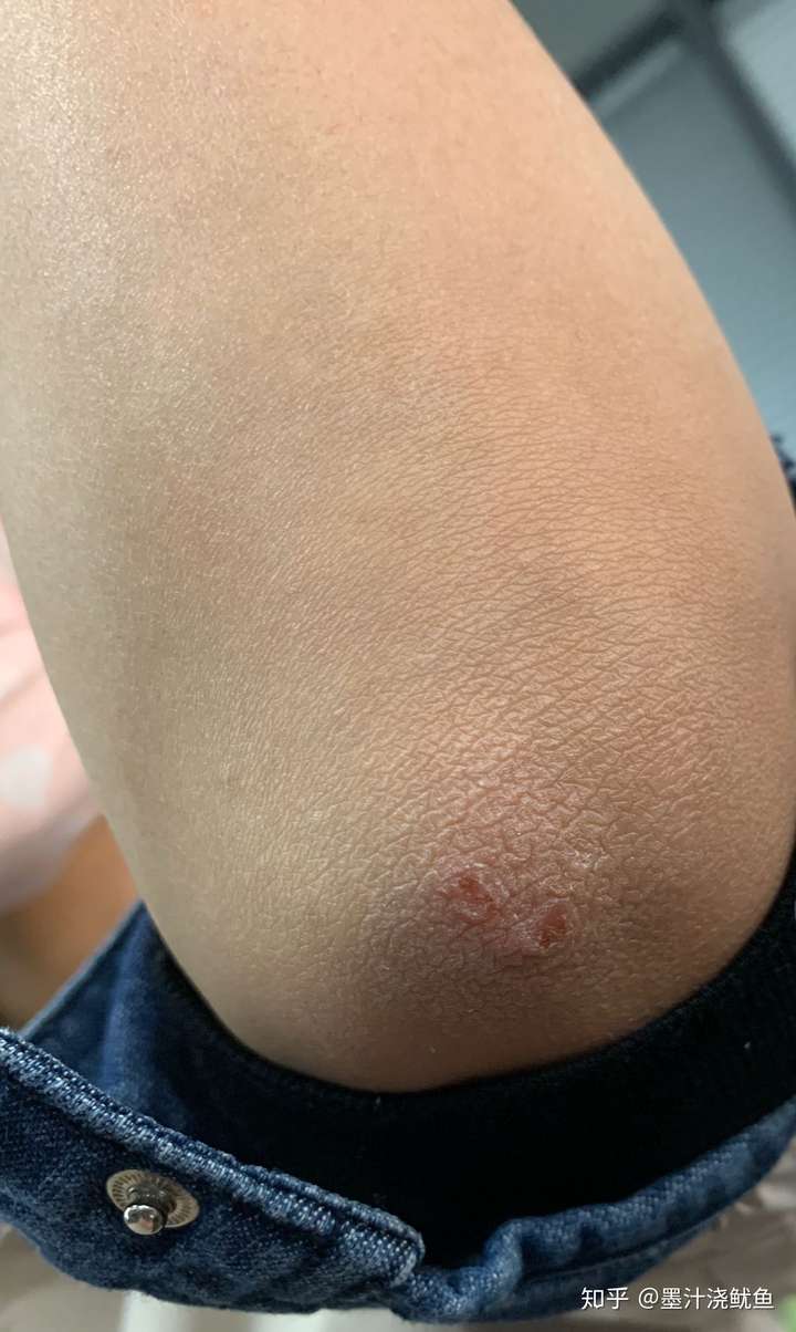 昨天刚洗过澡,我就拍一下我的胳膊肘