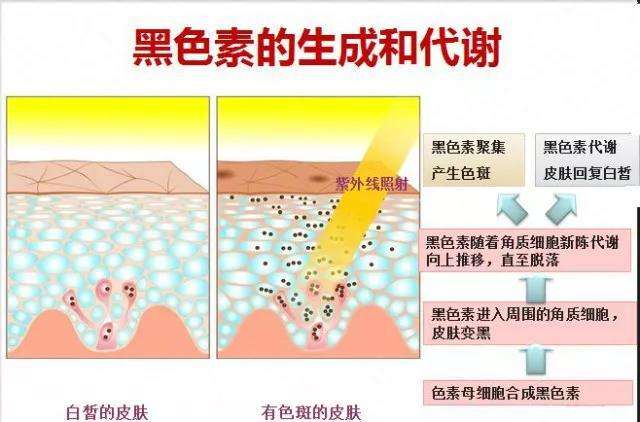 黑色素就会大量产生,就会不断向皮肤表皮转移,当它代谢不畅,尤其是当