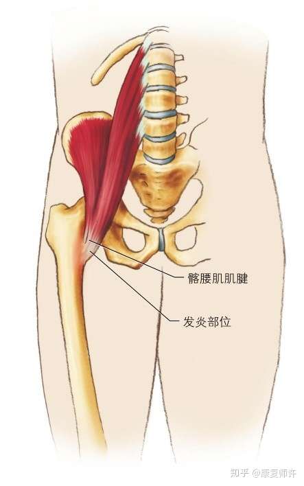 什么是髂腰肌肌腱炎