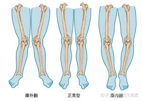 小腿外翻怎么改善 腿型不好看 夏天很自卑不敢穿短裤?