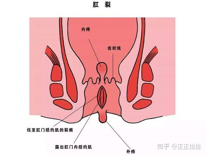 分别痔疮还是肛裂?