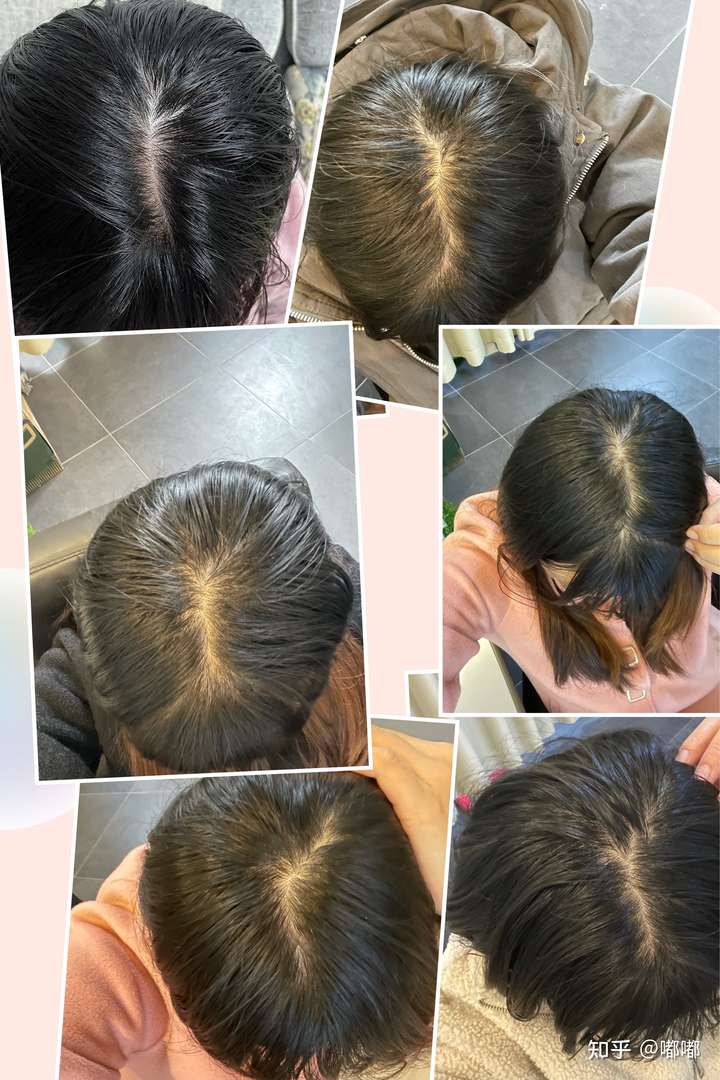 请问女孩子散开头发头顶是这样的算秃吗?