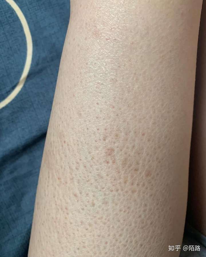 鸡皮肤怎么去除?