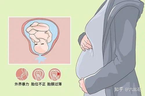 孕期准妈妈羊水破了有什么症状?
