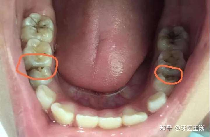 邻面龋有哪些表现?致病原因是什么?该如何预防和治疗呢?