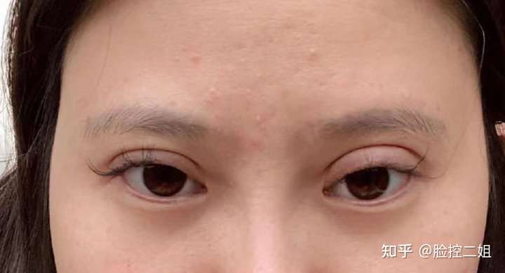 怎么能一看就看出是假双眼皮