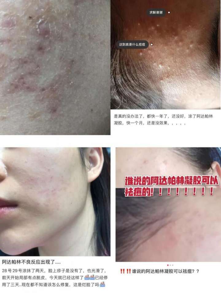 阿达帕林凝胶可以全脸用吗?