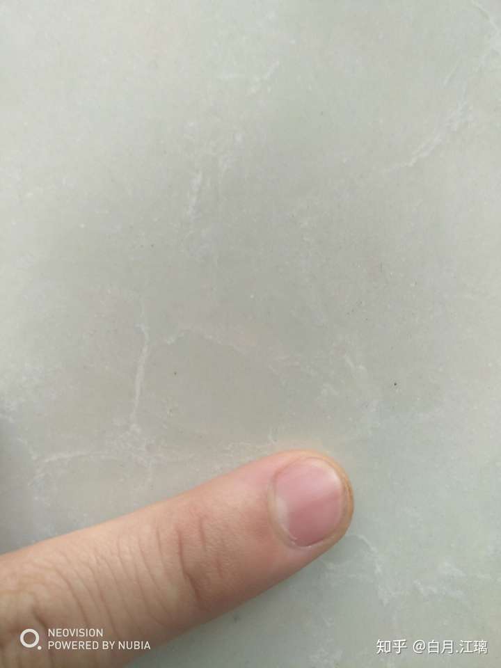 左手大拇指指甲有一条淡褐色竖线,好几年了,微量元素也正常,为什么啊?