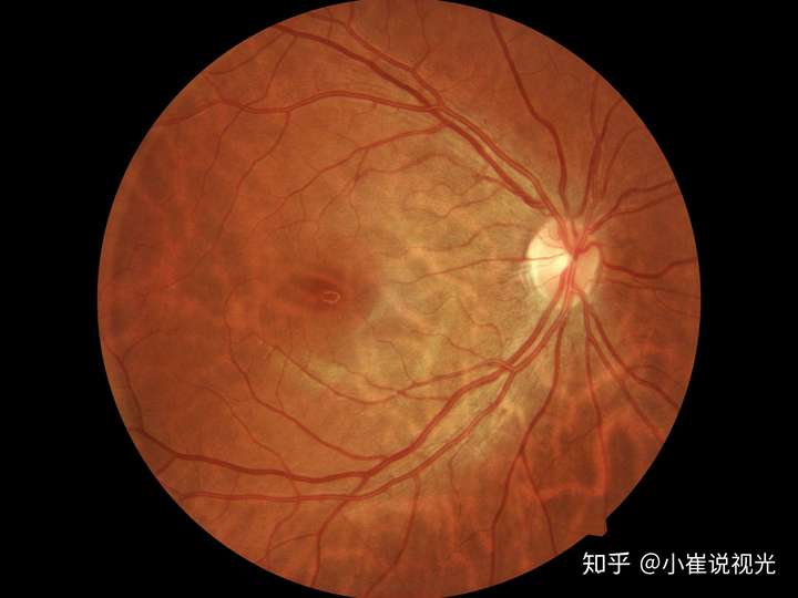 高度近视视网膜脱落的案例多吗,什么样的剧烈运动不能