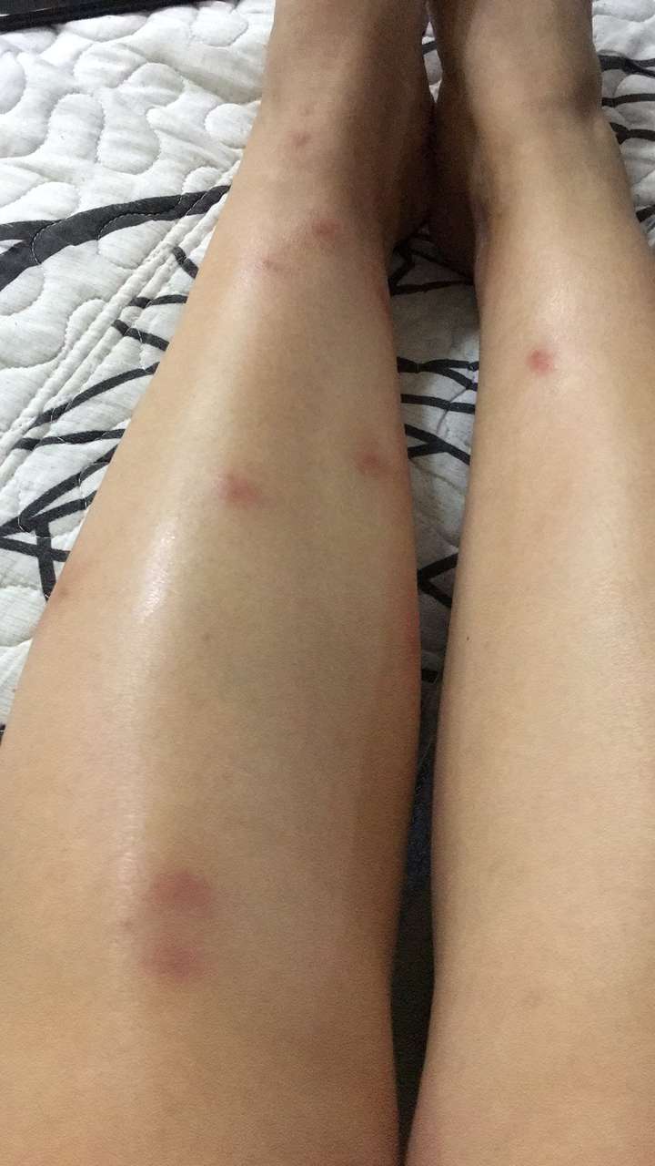 被蚊子咬的包第二天都肿的特别大怎办?