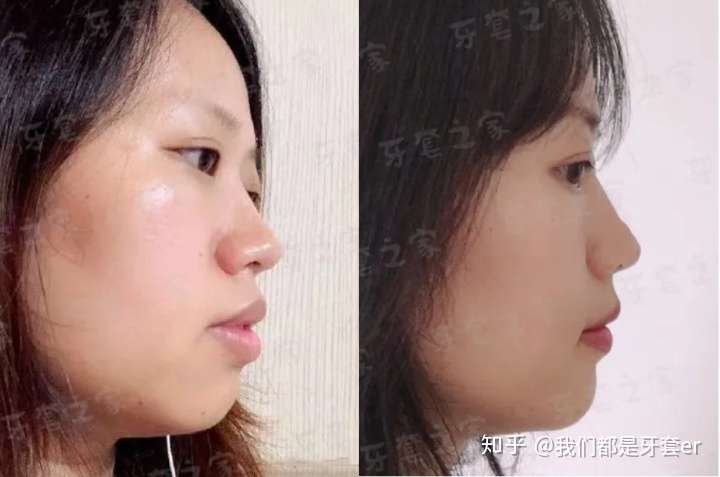 35岁后整牙的你成功了还是后悔了?