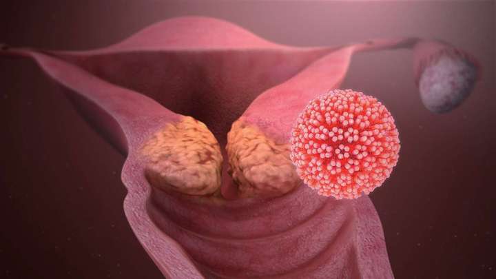 hpv—人乳头瘤病毒,令很多女性闻之色变,因为 hpv 跟宫颈癌密切相关