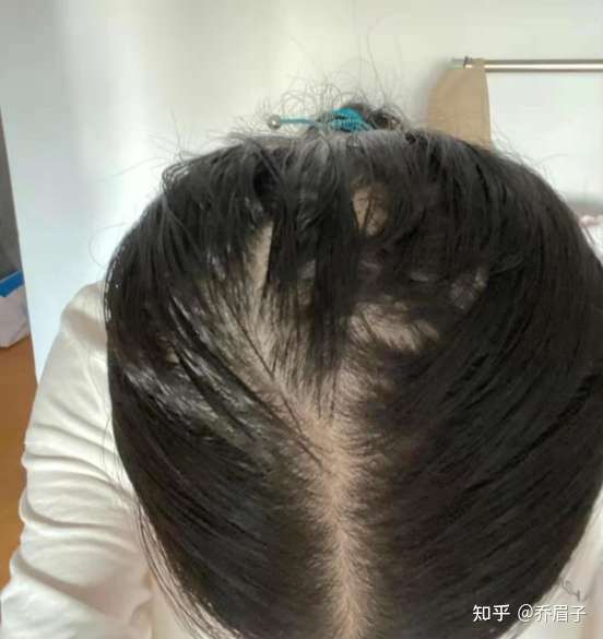 我也是突然掉发就很严重,然后头顶就这样子了.