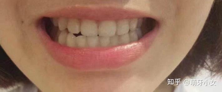 正常人的牙齿的健康颜色本来就是淡黄色,洁白的反而不健康了,多数是