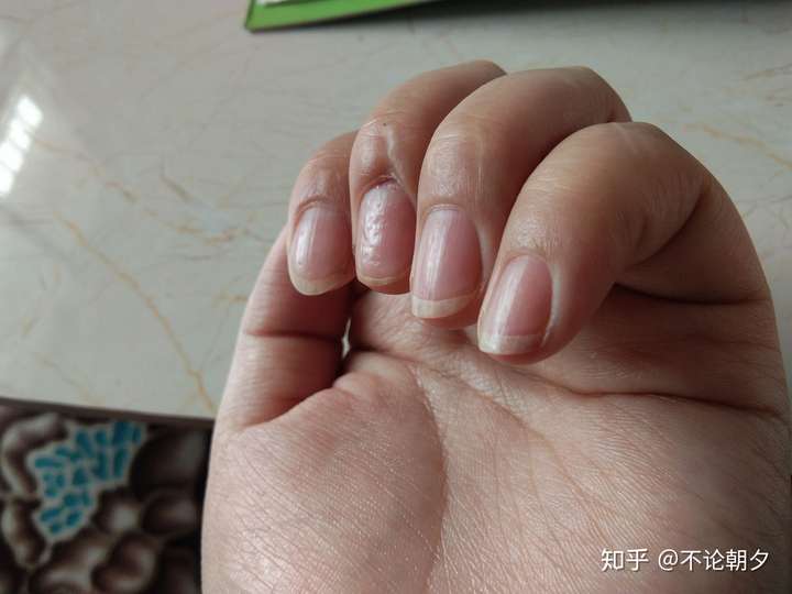 我的指甲印象中从小就坑坑洼洼,大学后凹陷的更厉害,还被家里当成灰