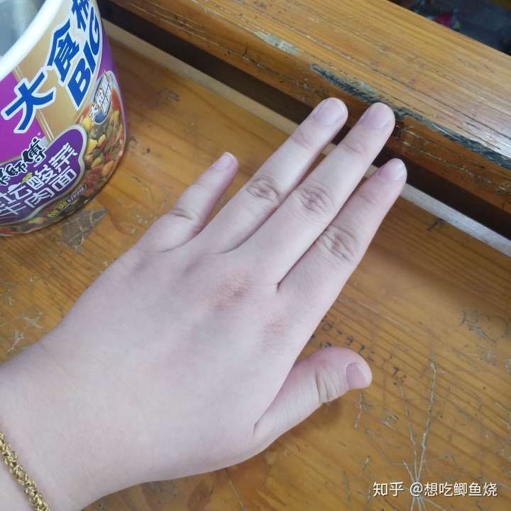 为什么我的大拇指又宽又短?