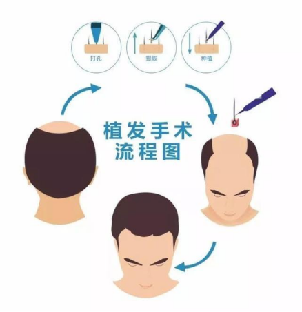 植发手术会有危害吗?