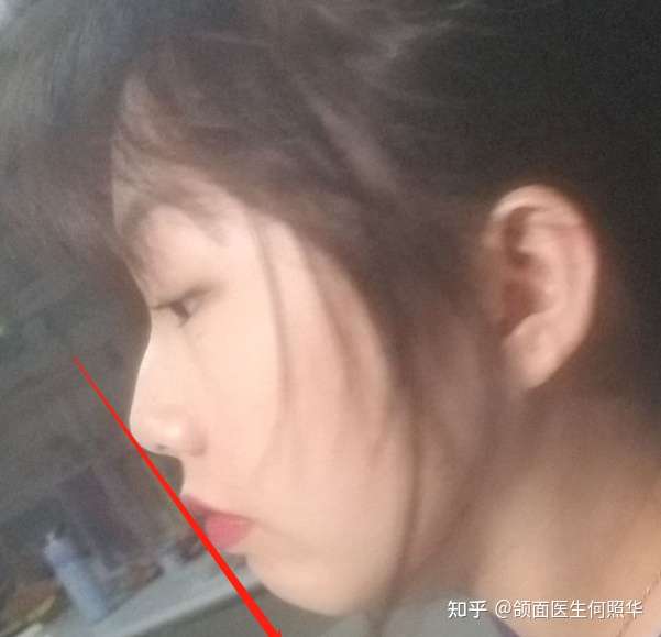 请问我这种侧脸如何改善谢谢?