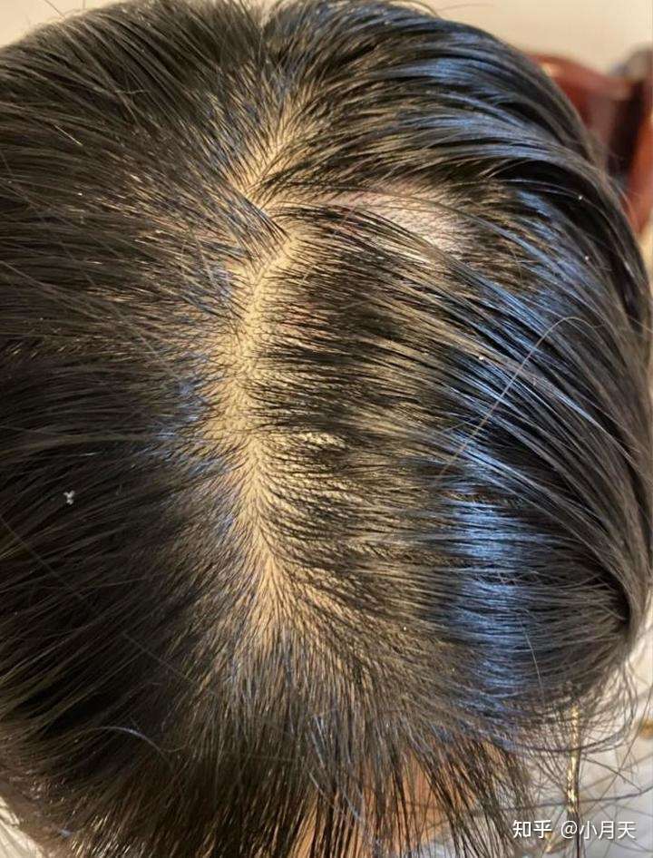 1 ,发量少 大多数人头发紧贴头皮的原因是发量少.
