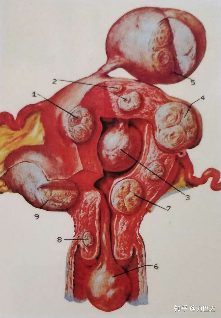 子宫肌瘤是怎么形成的?
