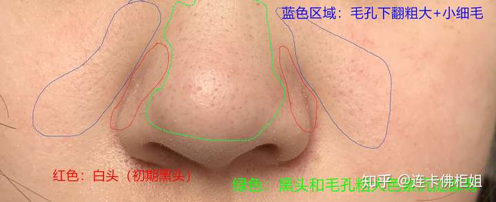 鼻翼部位:白头,也就是初期黑头, 白头老了发黑变脏变硬就是黑头.