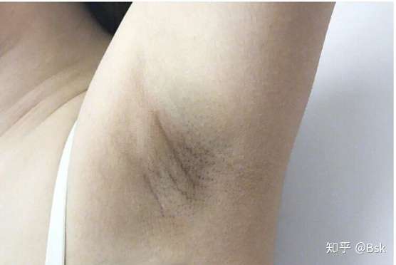 狐臭怎么判断?