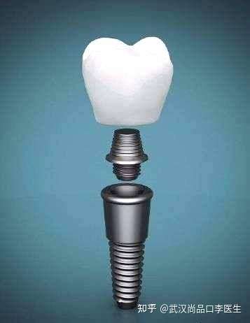 首先我们需要知道种植牙的结构,其实分为三个,种植体,基台和牙冠.