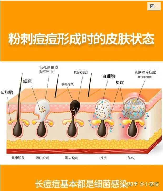 聊一个兴奋的问题大家脸上的痘痘是怎么消下去的