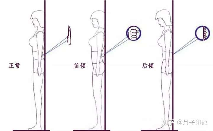 骨盆前倾如何矫正