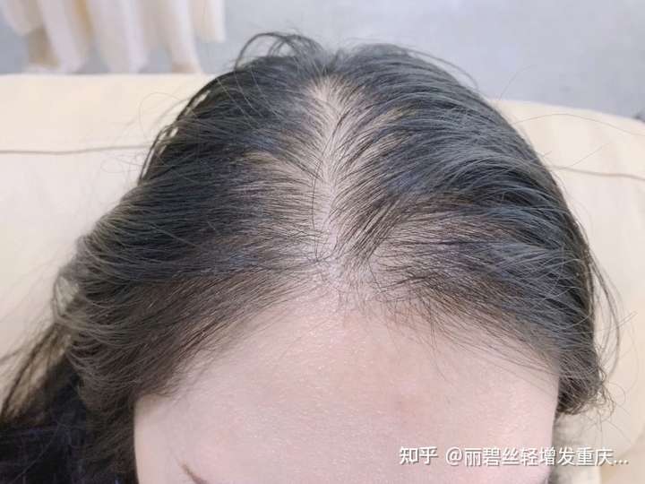 女孩子脱发怎么办 ?